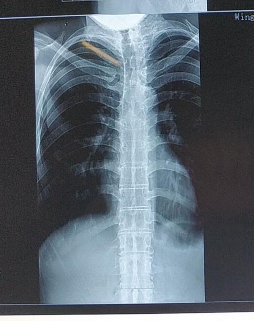 强直性脊柱炎检查骨盆