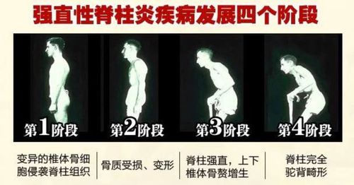 强直性脊柱炎引起手指肿痛