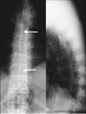 强直性脊柱炎进展期x线