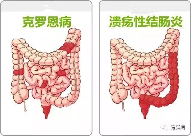 溃疡性结肠炎3年怎么治得好