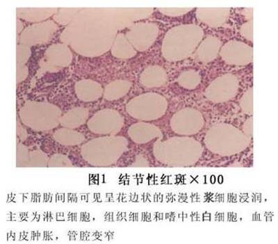 溃疡性结肠炎引起的红斑