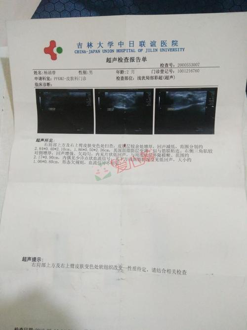 横纹肌肉瘤