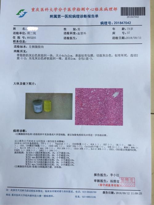 儿童非霍奇金淋巴瘤