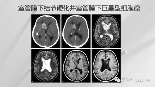 结节性硬化症