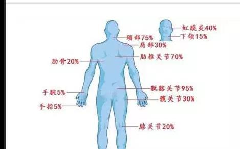 强直性脊柱炎可以考公么