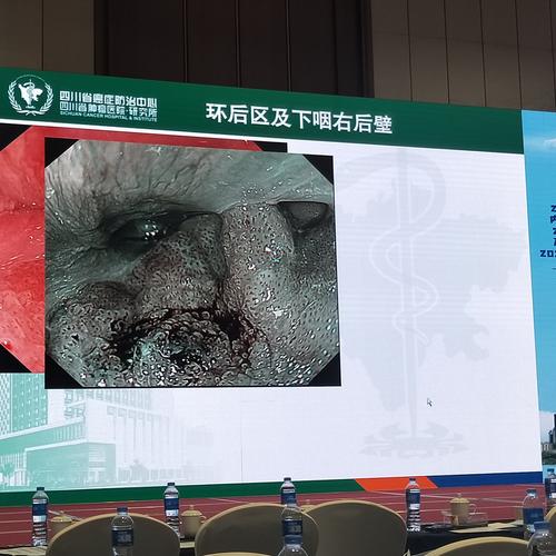 下咽癌