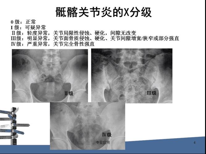 单位体检能查出强直性脊柱炎