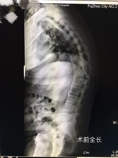 强直性脊柱炎典型病例