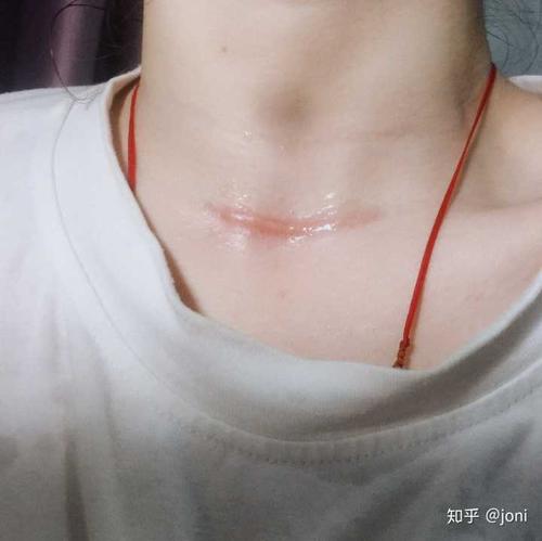甲状腺癌