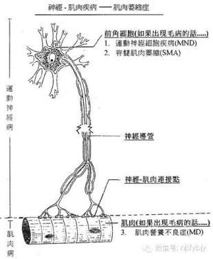 脊髓性肌萎缩症