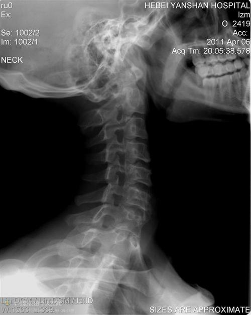 强直性脊柱炎可以做肩颈操吗