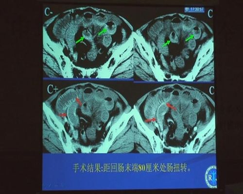 绞窄性肠梗阻和溃疡性结肠炎区别