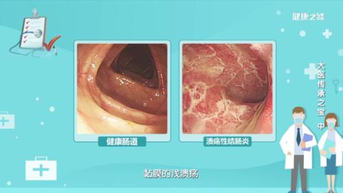 抗酸杆菌溃疡性结肠炎