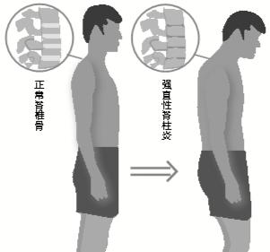 强直性脊柱炎小便出来黄吗
