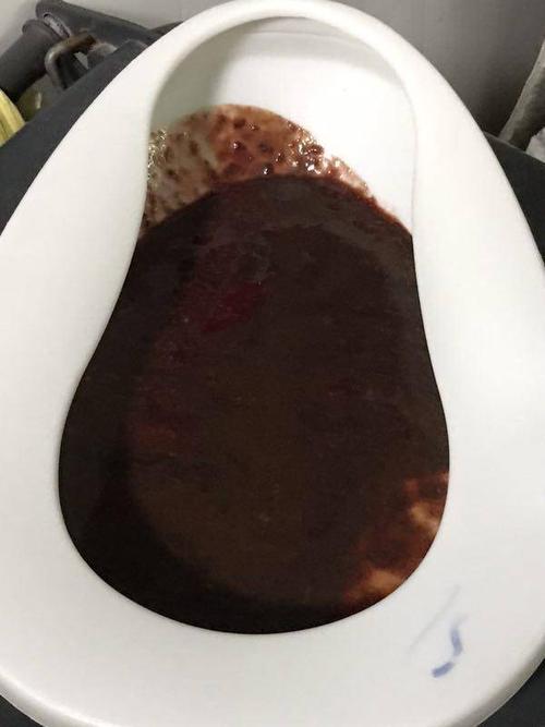 溃疡性结肠炎便血腹胀