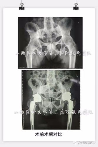 强直性脊柱炎髋关节受累