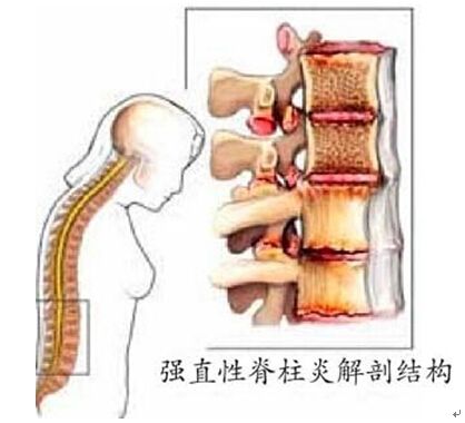 强直性脊柱炎儿童