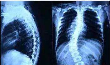 强直性脊柱炎发病