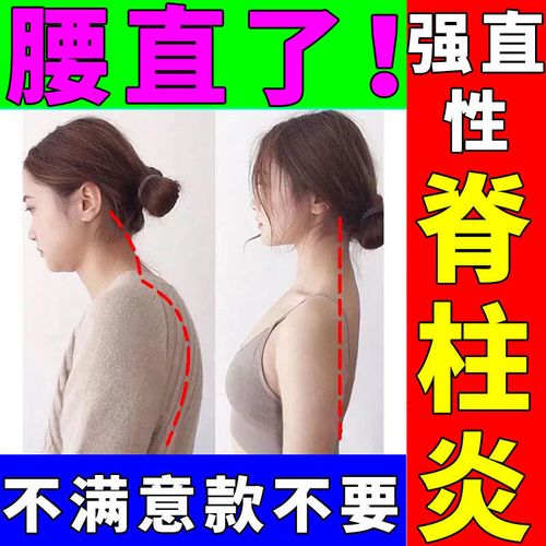 年轻人强直性脊柱炎区别圆肩驼背