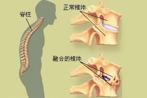 强直性脊柱炎很疼吗