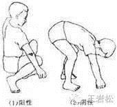 强直性脊柱炎会引起畸形吗