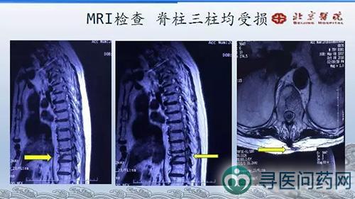 强直性脊柱炎骨折