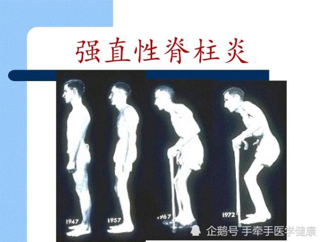 强直性脊柱炎慢性炎症