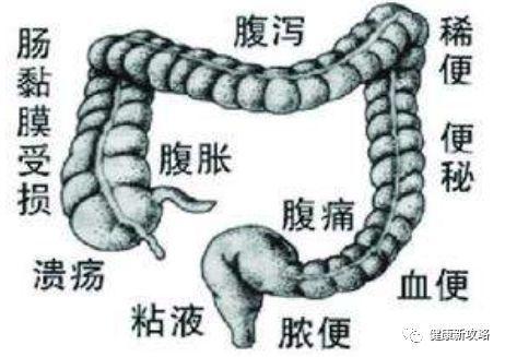 溃疡性结肠炎两年不复查