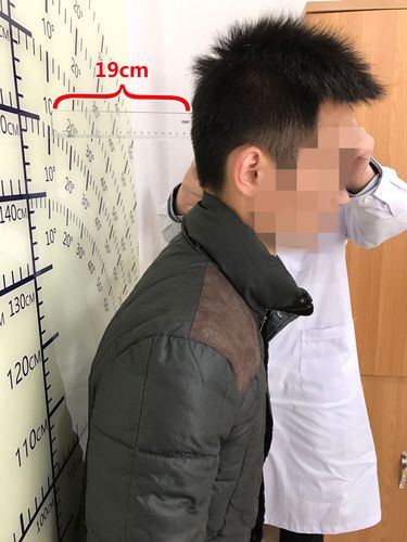 强直性脊柱炎驼背图