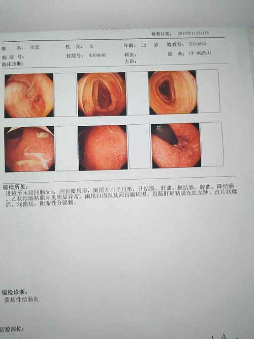 溃疡性的结肠炎容易放屁怎么回事