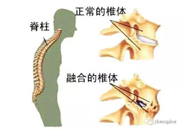 强直性脊柱炎的外周症状
