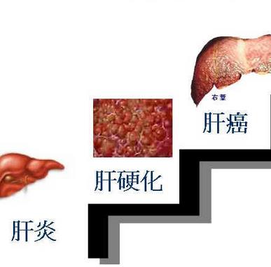 肝癌