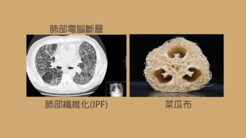 肺纤维化