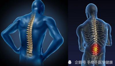 强直性脊柱炎的治疗突破