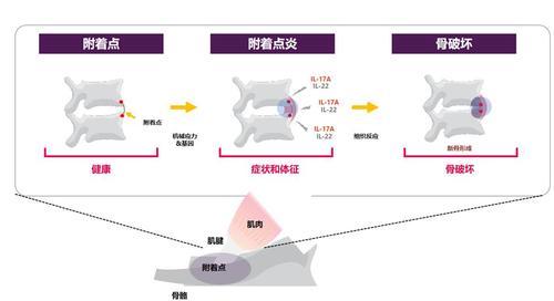 基因疗法治愈强直性脊柱炎