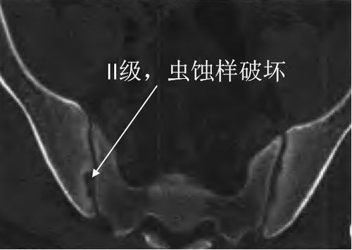 强直性脊柱炎二级