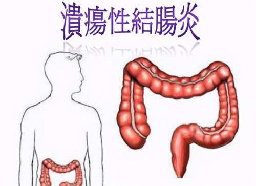 溃疡性结肠炎可怕吗