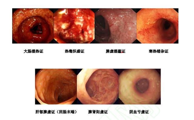 溃疡性结肠炎抑郁了