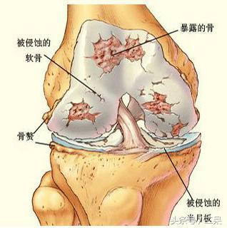 强直性脊柱炎引起腿疼