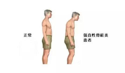 强直性脊柱炎是不是真的废了