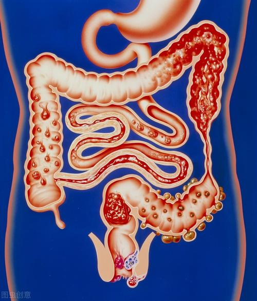 腰骶部疼痛直肠型溃疡性结肠炎