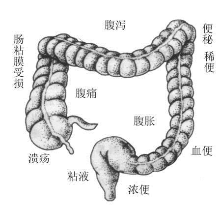 有溃疡性结肠炎肚子胀怎么办