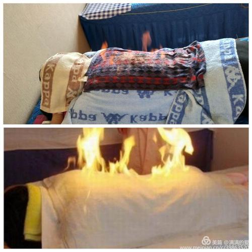 火疗对强直性脊柱炎有疗效吗