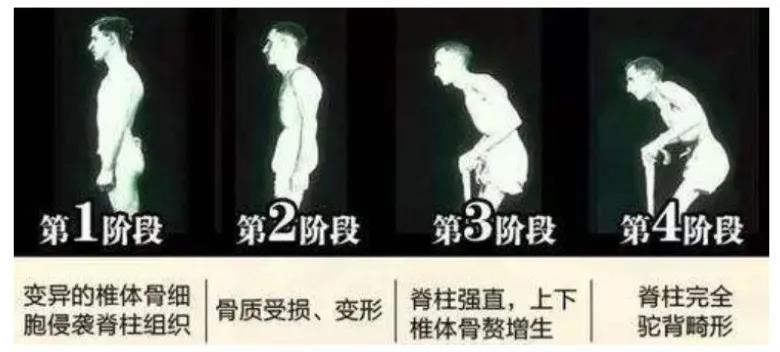 强直性脊柱炎肚子像鼓一样硬