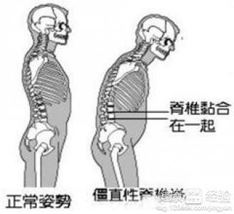 椎间盘膨出能变成强直性脊柱炎吗