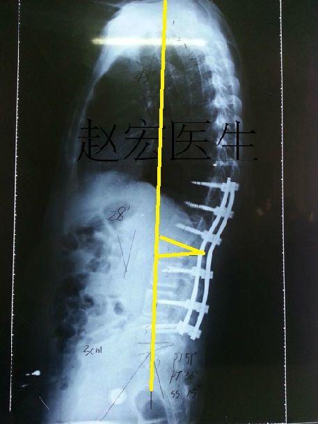 强直性脊柱炎治疗