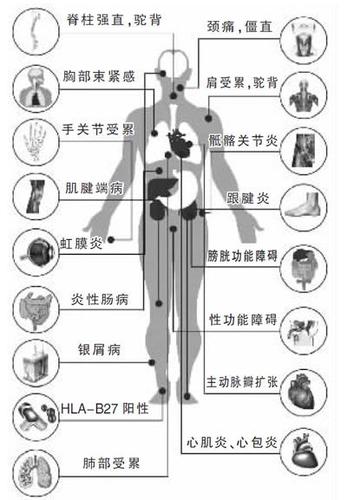 强直性脊柱炎病人饮食