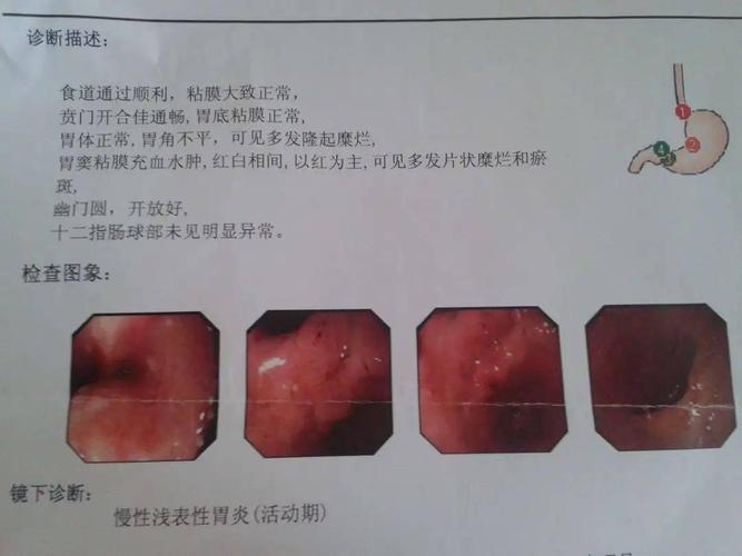 溃疡性慢性结肠炎症状