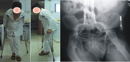 女性患上强直性脊柱炎