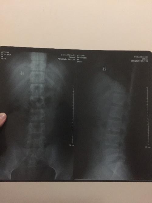 as强直性脊柱炎